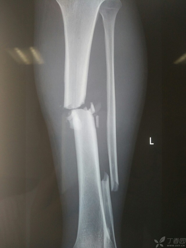 科技重塑脛腓骨骨折康復(fù)之旅，引領(lǐng)未來體驗(yàn)新篇章