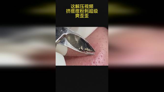 最新擠膿包視頻，見證變化的力量，自信與成就感的誕生之地