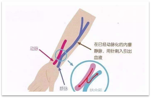 靜脈瘺最新資訊，掌握最前沿的健康信息